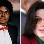 Michael jackson vitalago autoimmune skin condition from black to white