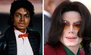 Michael jackson vitalago autoimmune skin condition from black to white